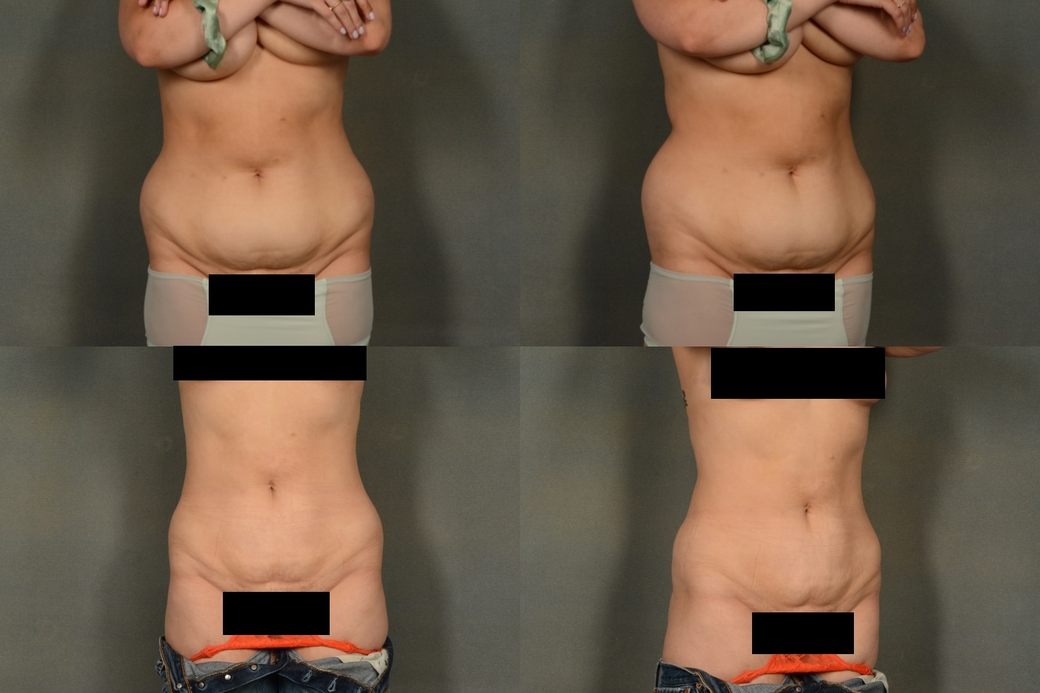 Liposuction Case# 993 Combined Image