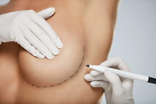 How Long Do Breast Implant Last? Image