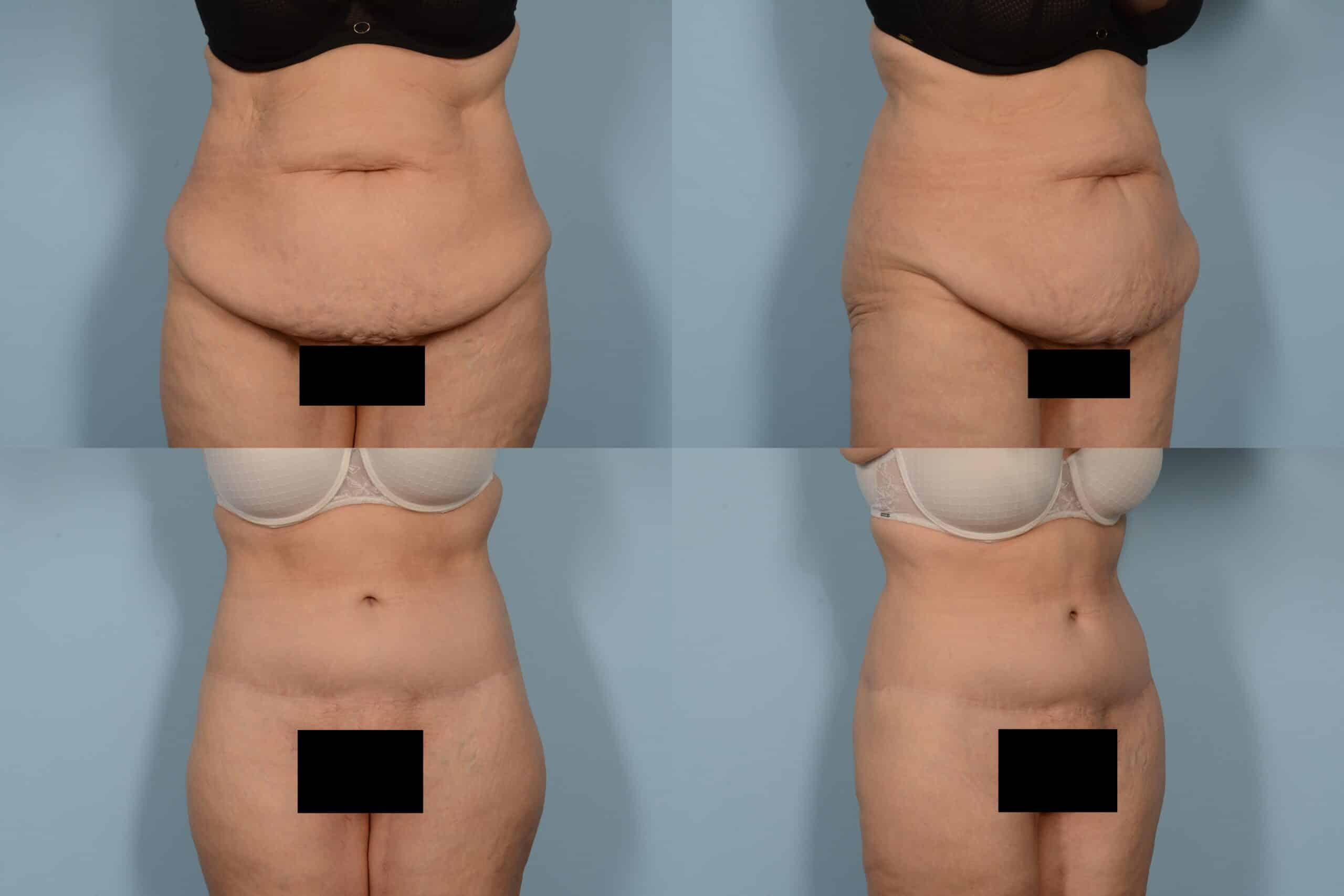 Tummy Tuck Case# 1147 Combined Image