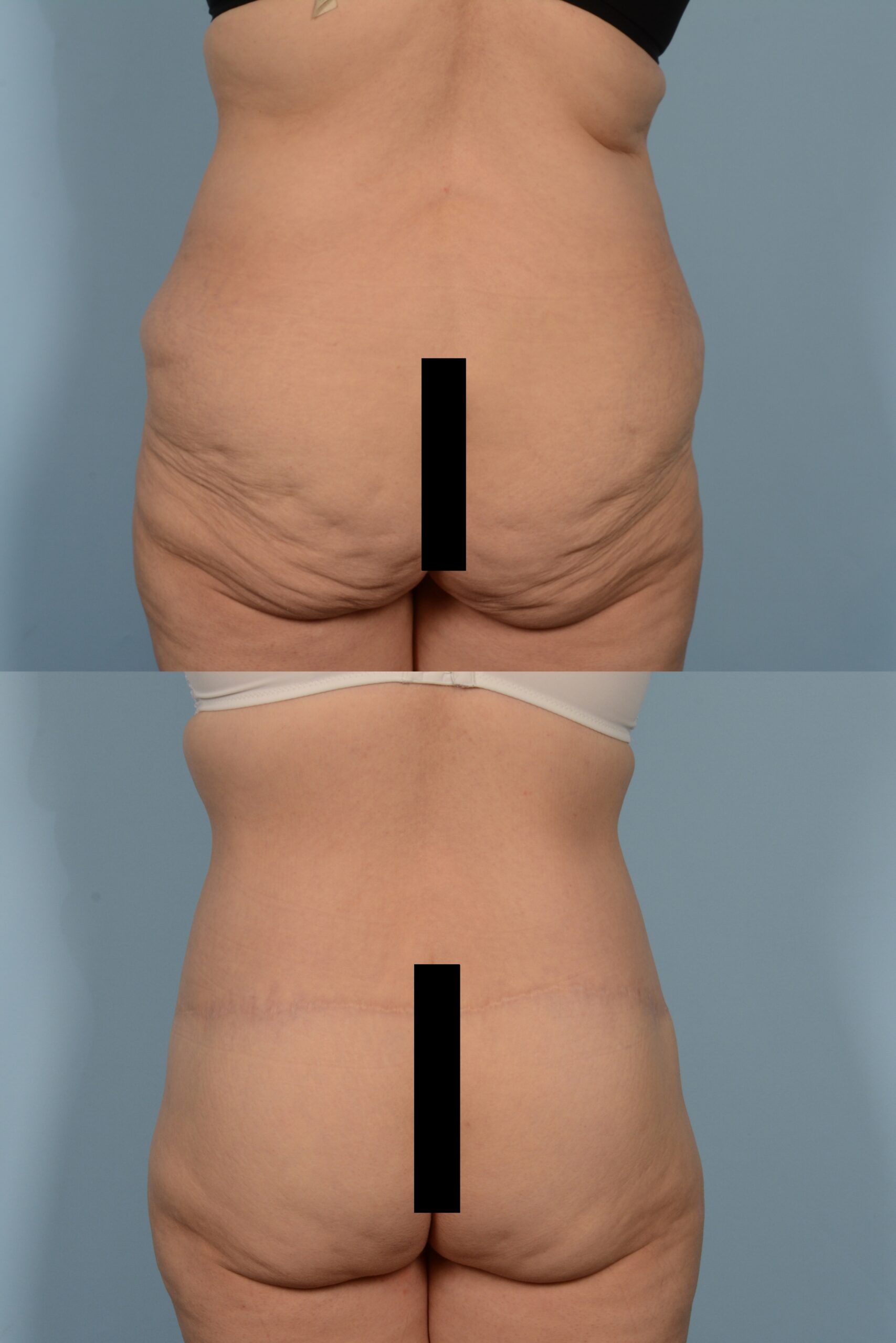 Back Lift Case# 1148 Combined Image