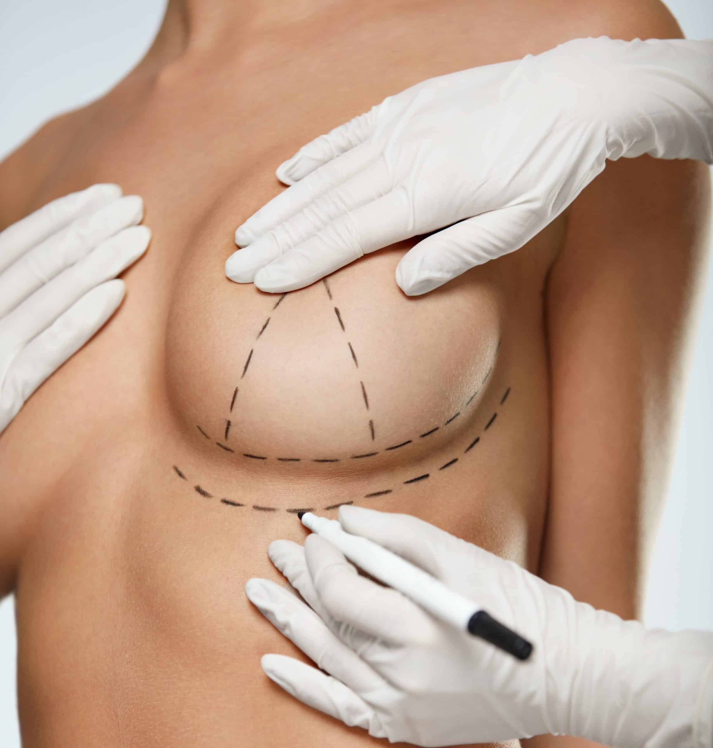 What to Expect After Breast Reduction Surgery Image