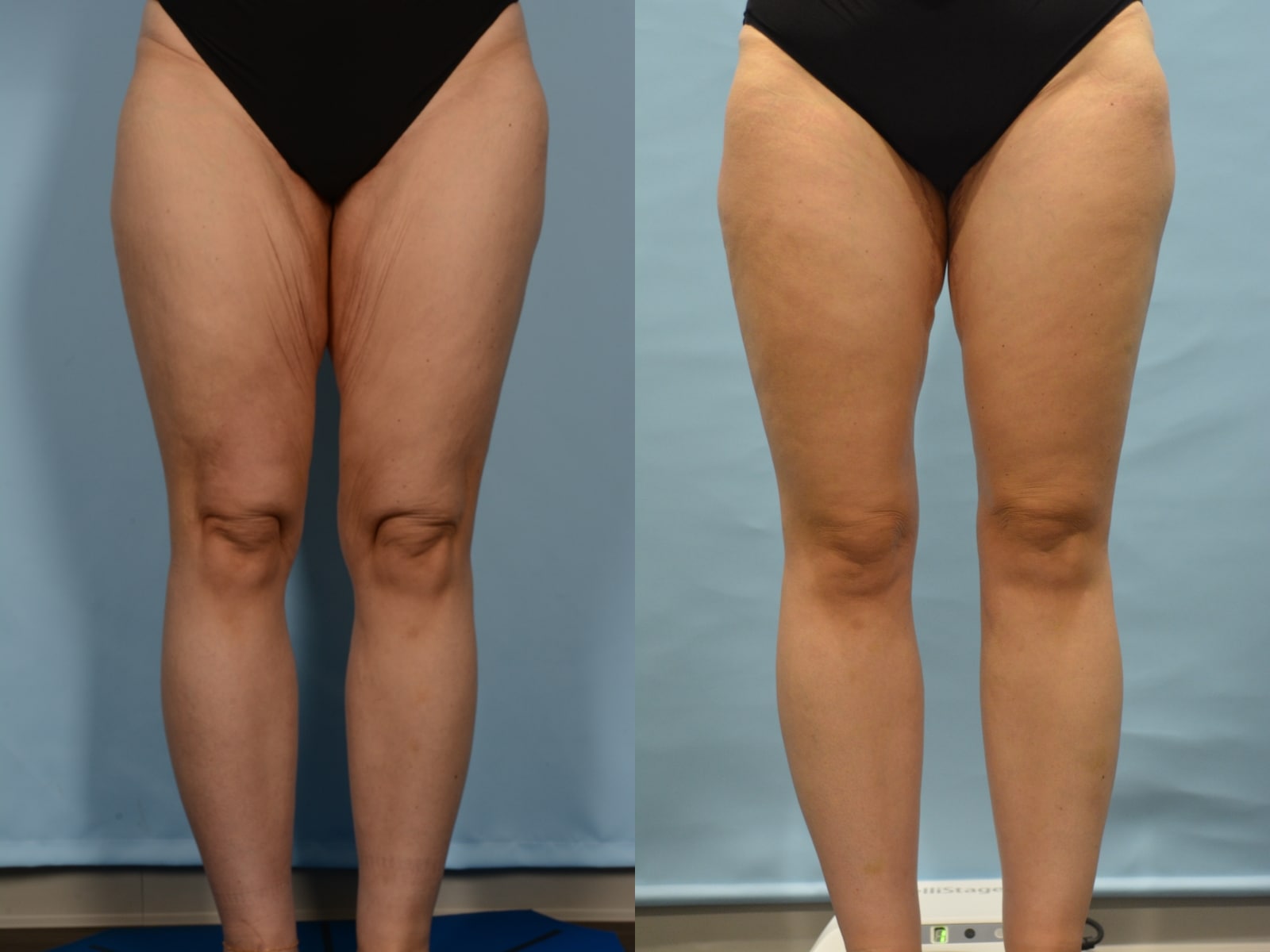 Thigh Lift Case# 1216 Combined Image