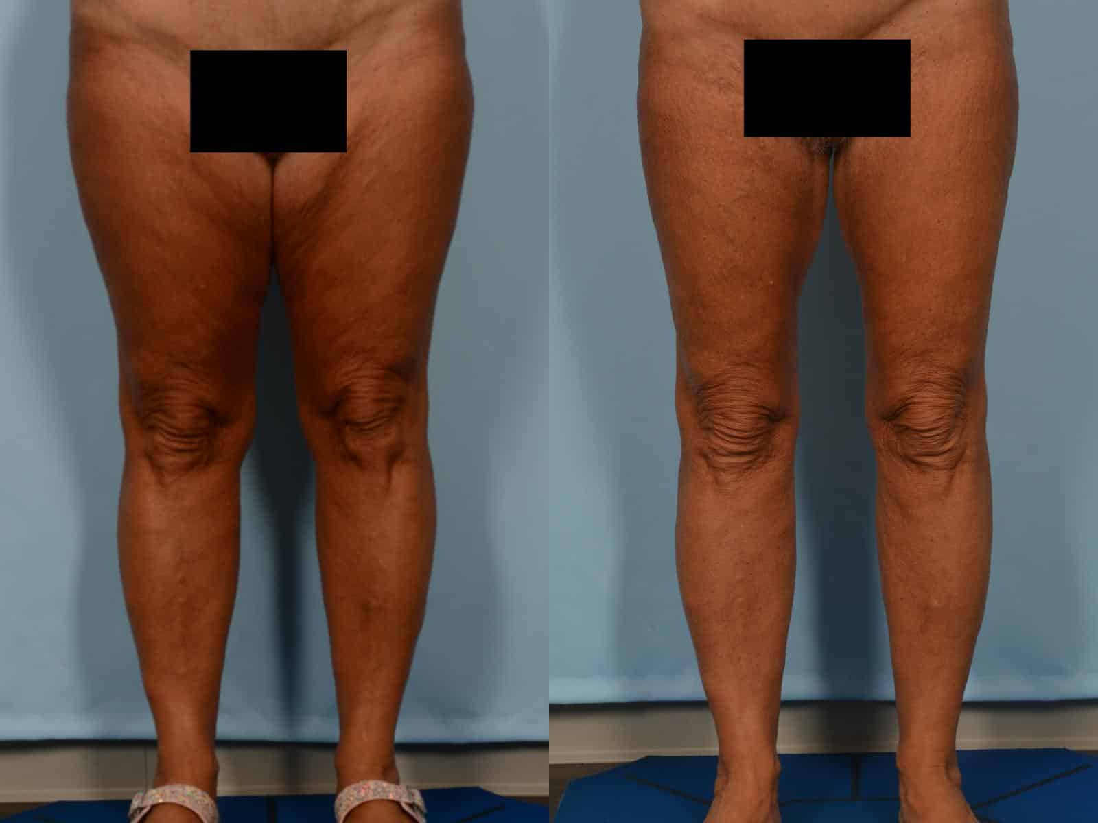 Thigh Lift Case# 1217 Combined Image