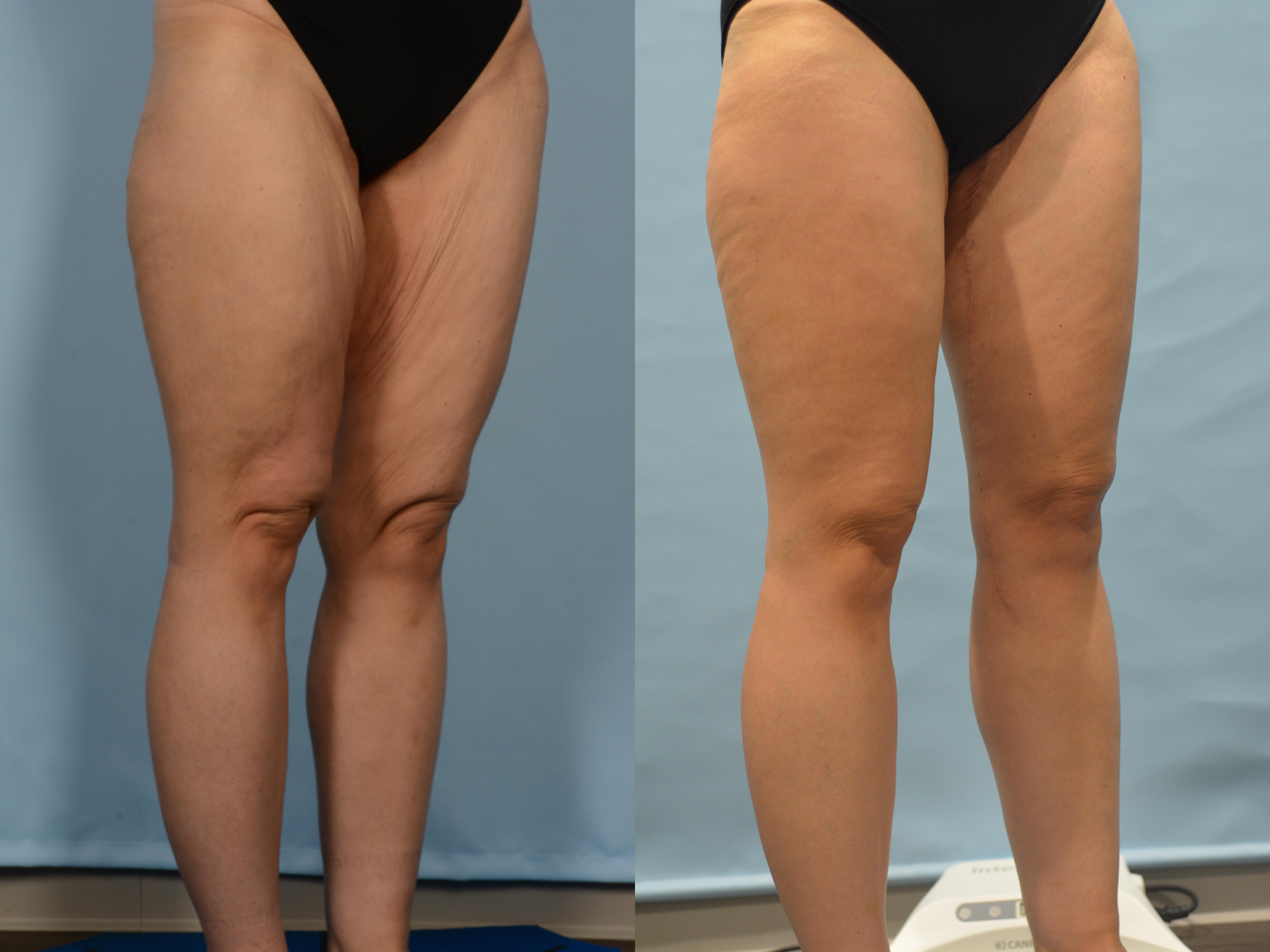 Thigh Lift Case# 1216 Combined Image