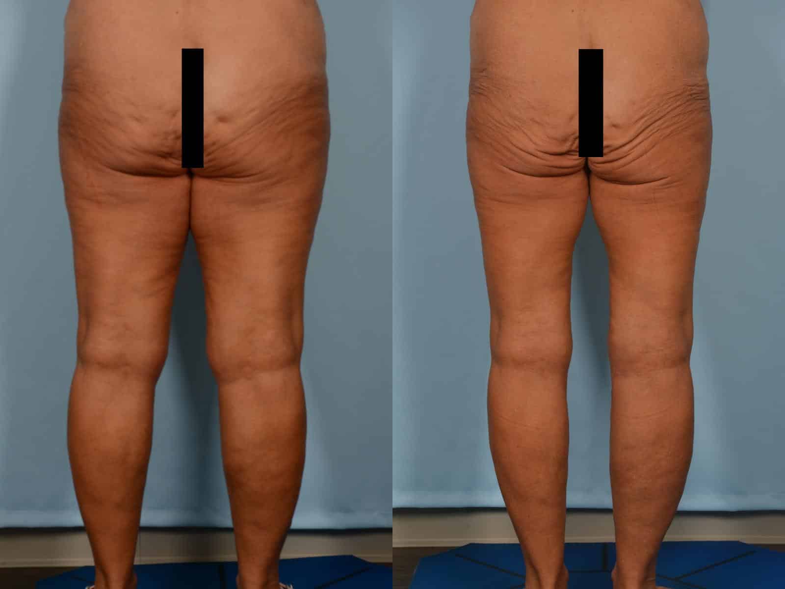 Thigh Lift Case# 1217 Combined Image