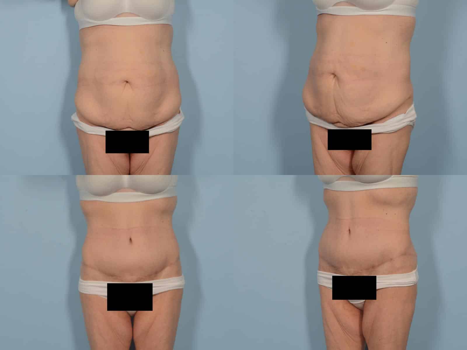 Tummy Tuck Case# 1219 Combined Image