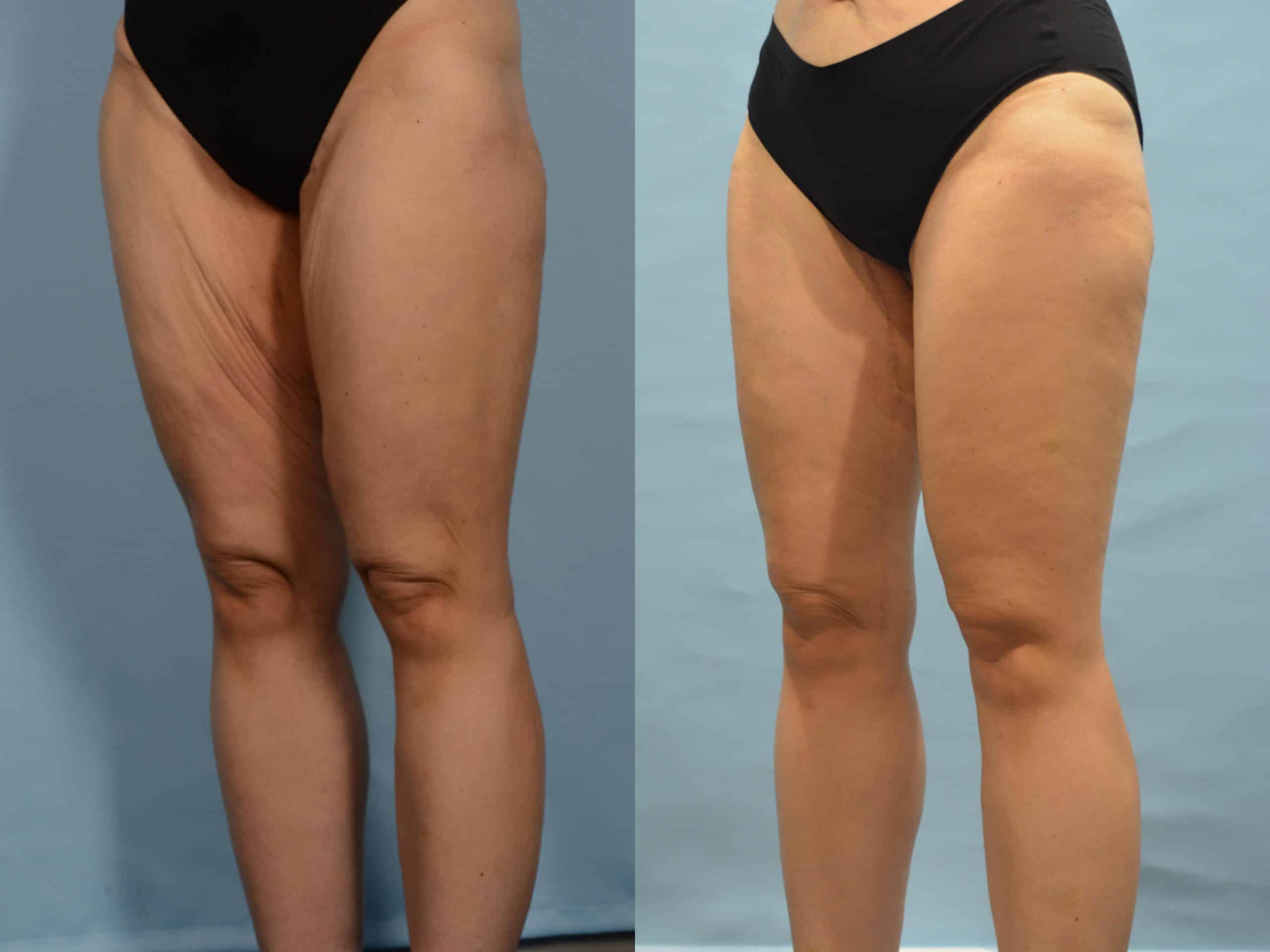 Thigh Lift Case# 1216 Combined Image